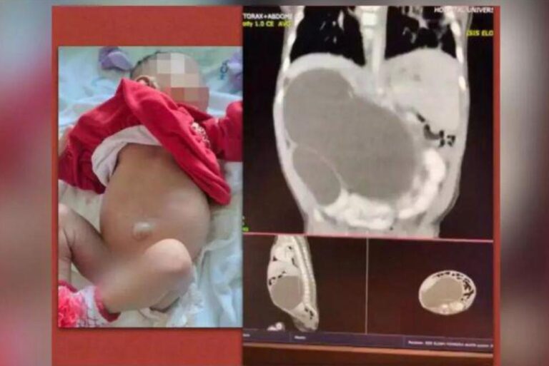 4 किडनी के साथ बच्ची के जन्म का बेहद दुर्लभ मामला ब्राज़ील में आया सामने